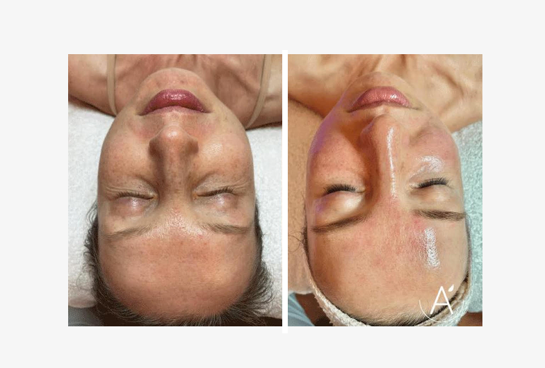 HydraFacial Before and After Results